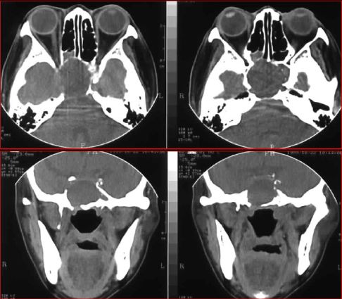 鼻窦炎影像诊断-37 鼻窦炎影像诊断-37