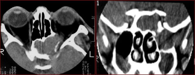 鼻窦炎影像诊断-38 鼻窦炎影像诊断-38