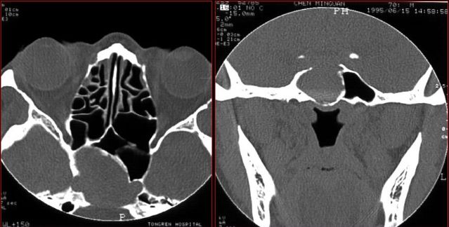 鼻窦炎影像诊断-39 鼻窦炎影像诊断-39