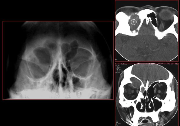 鼻窦炎影像诊断-41 鼻窦炎影像诊断-41