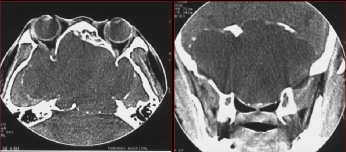 鼻窦炎影像诊断-40 鼻窦炎影像诊断-40