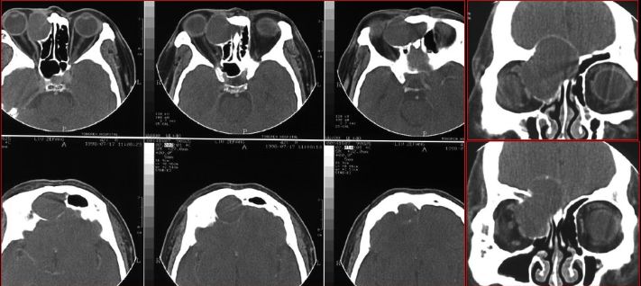 鼻窦炎影像诊断-42 鼻窦炎影像诊断-42