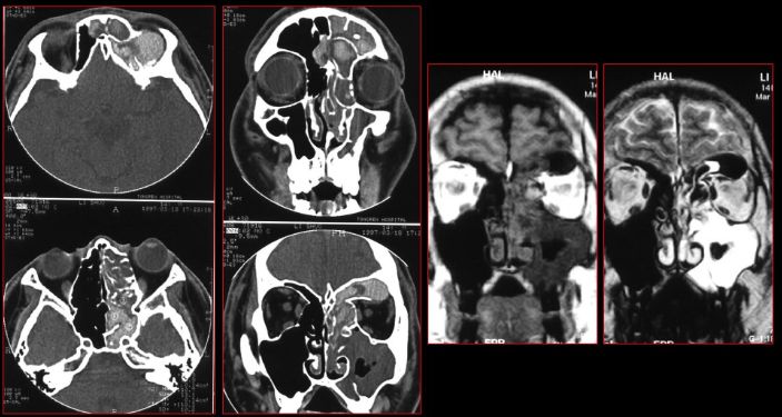 鼻窦炎影像诊断-44 鼻窦炎影像诊断-44