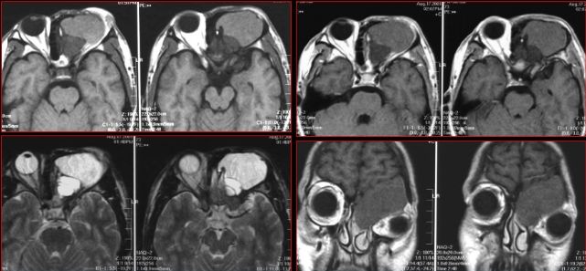 鼻窦炎影像诊断-43 鼻窦炎影像诊断-43
