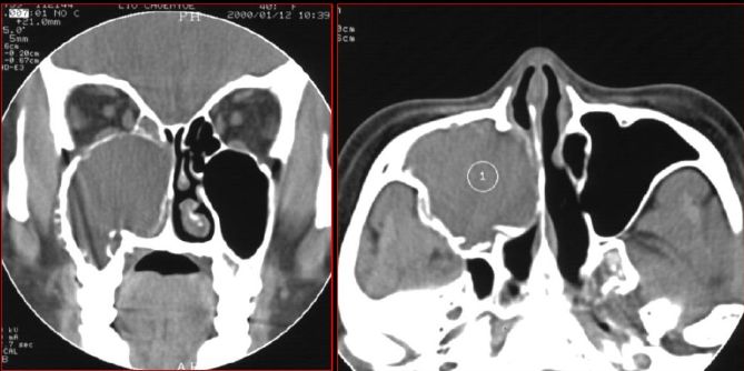 鼻窦炎影像诊断-46 鼻窦炎影像诊断-46