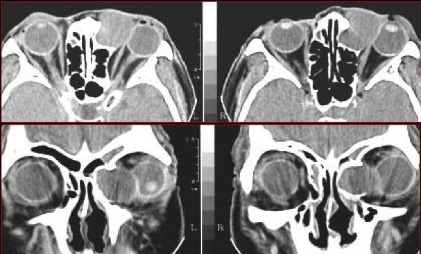 鼻窦炎影像诊断-45 鼻窦炎影像诊断-45