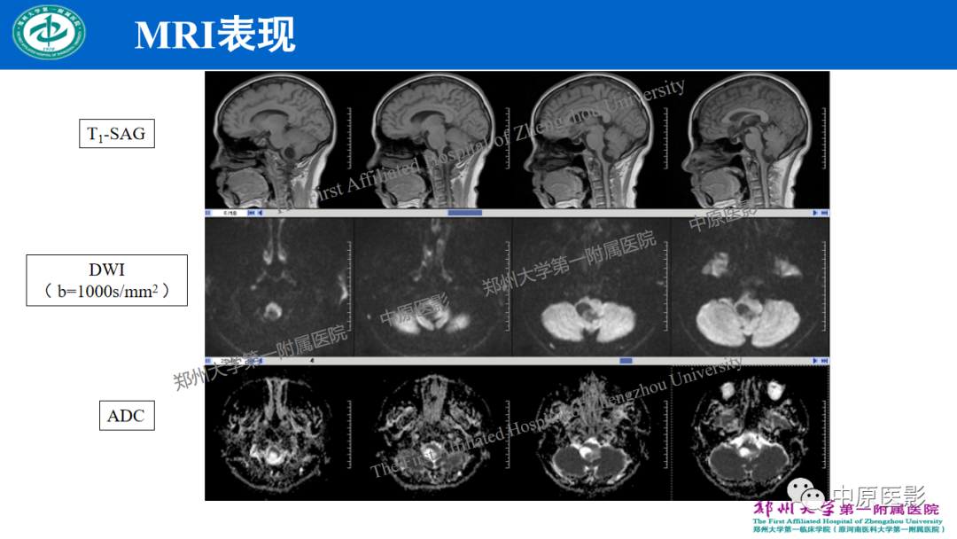 【病例】枕骨大孔区脉络丛乳头状瘤1例MR影像-4