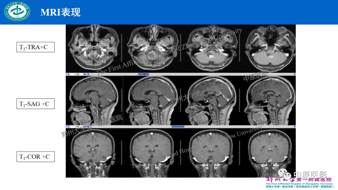 【病例】枕骨大孔区脉络丛乳头状瘤1例MR影像-5