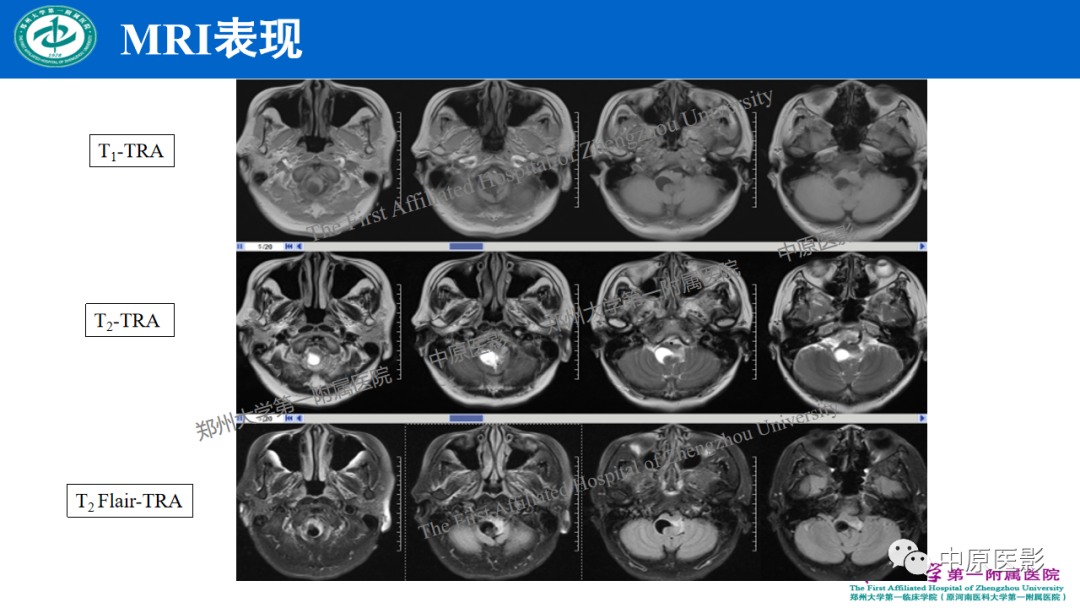【病例】枕骨大孔区脉络丛乳头状瘤1例MR影像-3