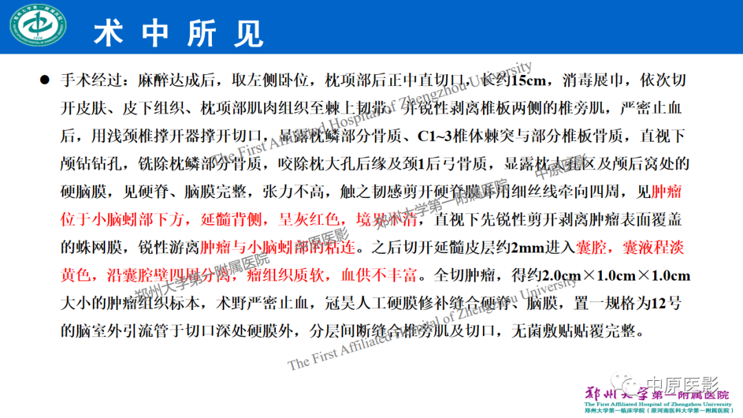 【病例】枕骨大孔区脉络丛乳头状瘤1例MR影像-7