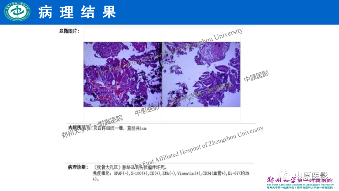 【病例】枕骨大孔区脉络丛乳头状瘤1例MR影像-8