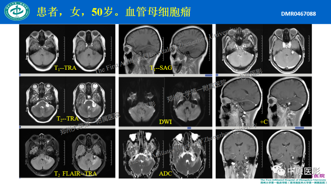 【病例】枕骨大孔区脉络丛乳头状瘤1例MR影像-13