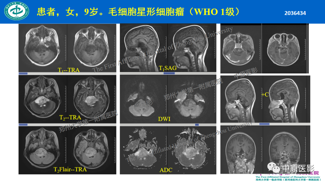 【病例】枕骨大孔区脉络丛乳头状瘤1例MR影像-16