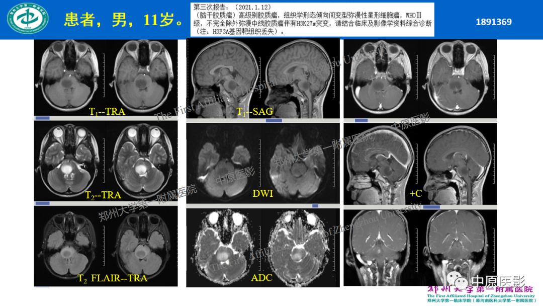 【病例】枕骨大孔区脉络丛乳头状瘤1例MR影像-18