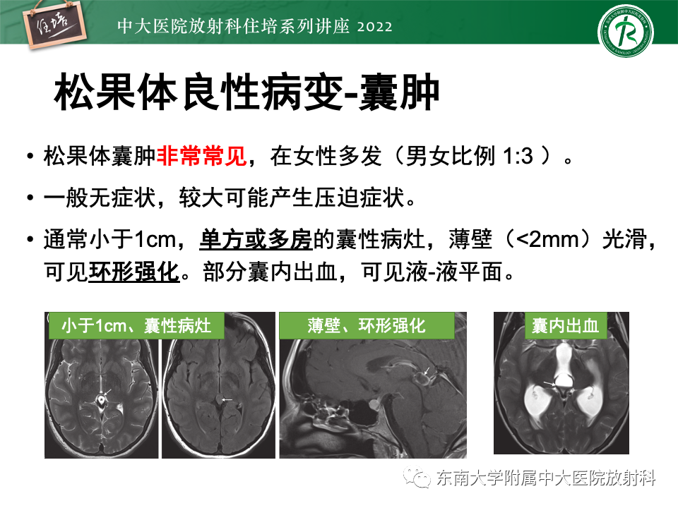 【PPT】松果体区占位性病变的诊断思路-4