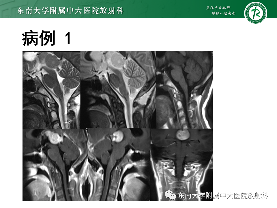 【PPT】松果体区占位性病变的诊断思路-10