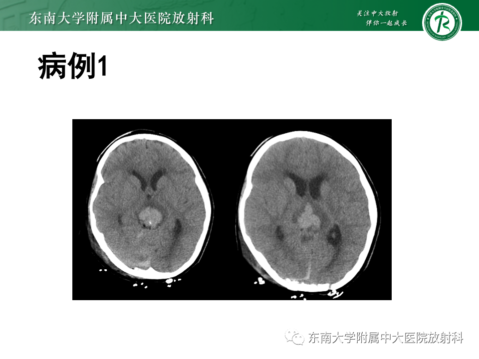 【PPT】松果体区占位性病变的诊断思路-9