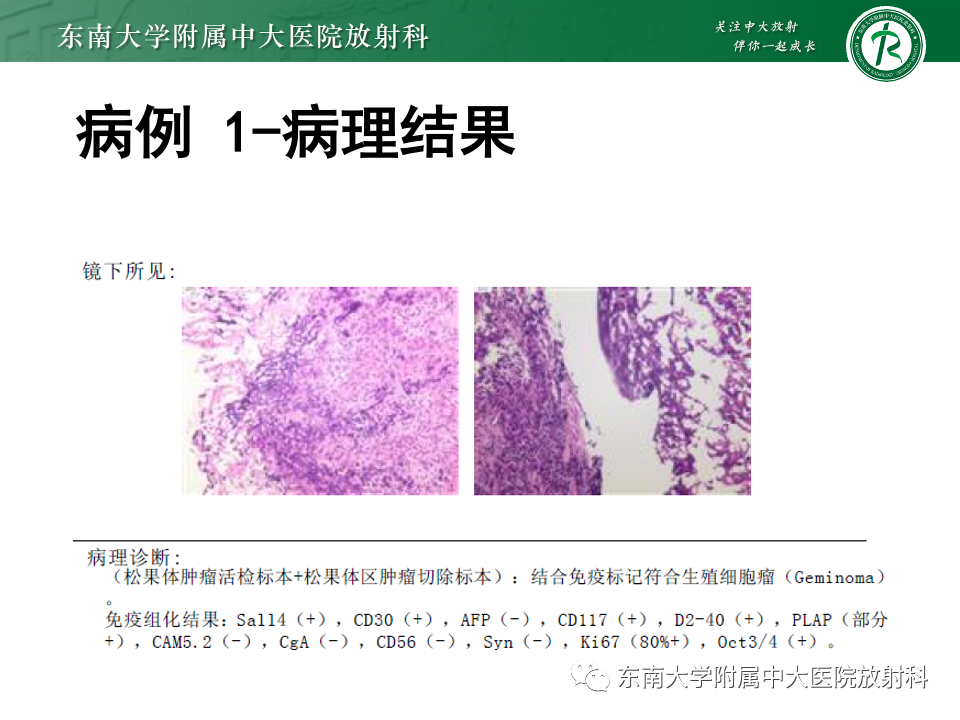 【PPT】松果体区占位性病变的诊断思路-11