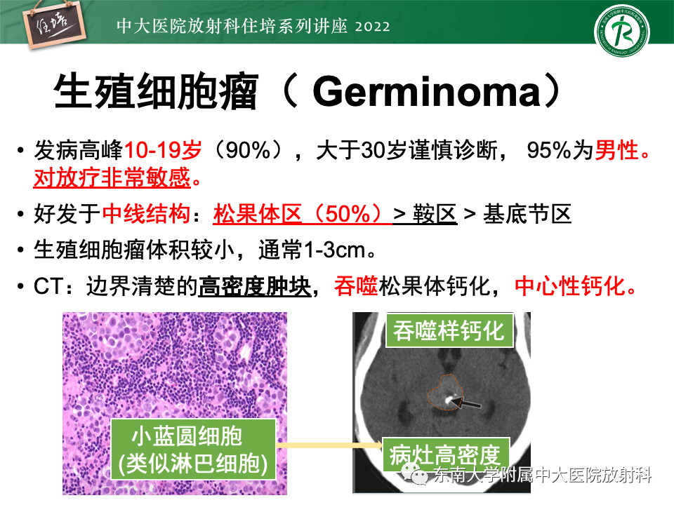 【PPT】松果体区占位性病变的诊断思路-15