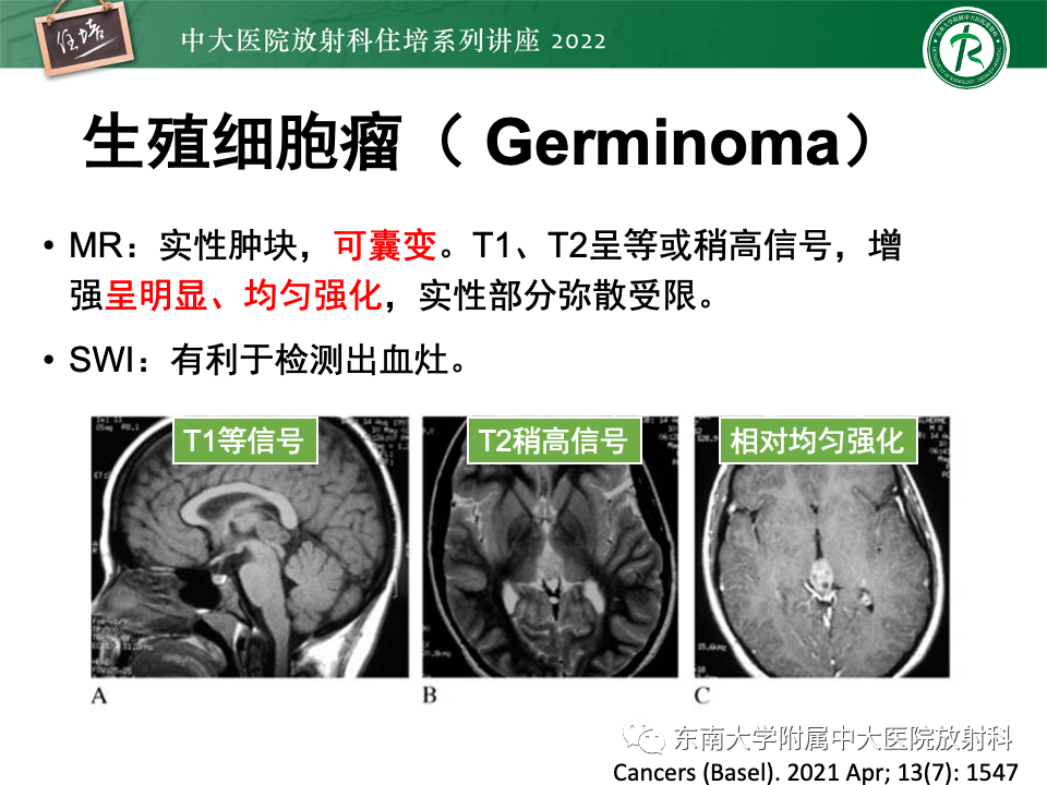 【PPT】松果体区占位性病变的诊断思路-16