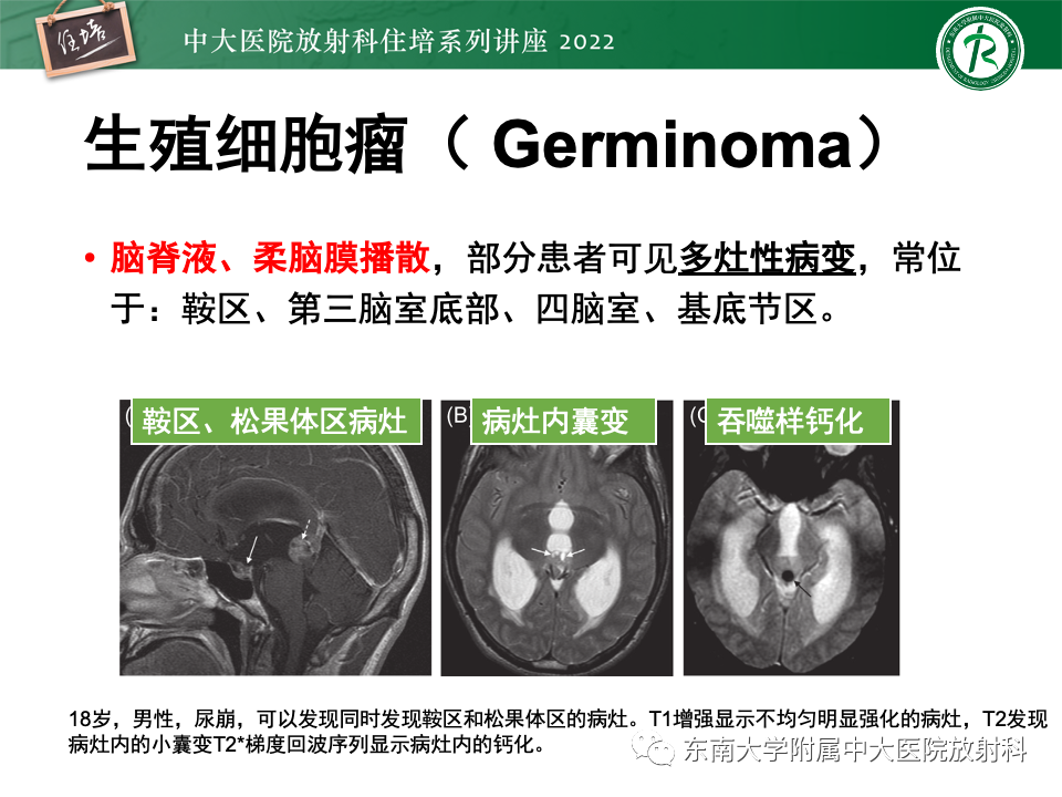 【PPT】松果体区占位性病变的诊断思路-17