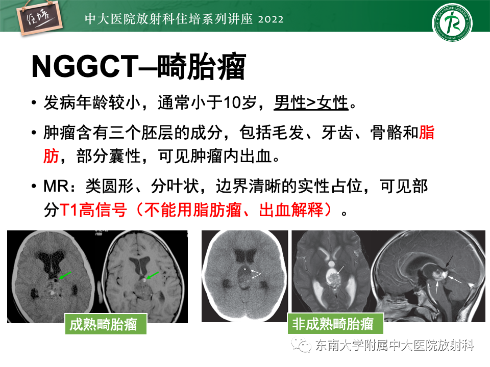 【PPT】松果体区占位性病变的诊断思路-19