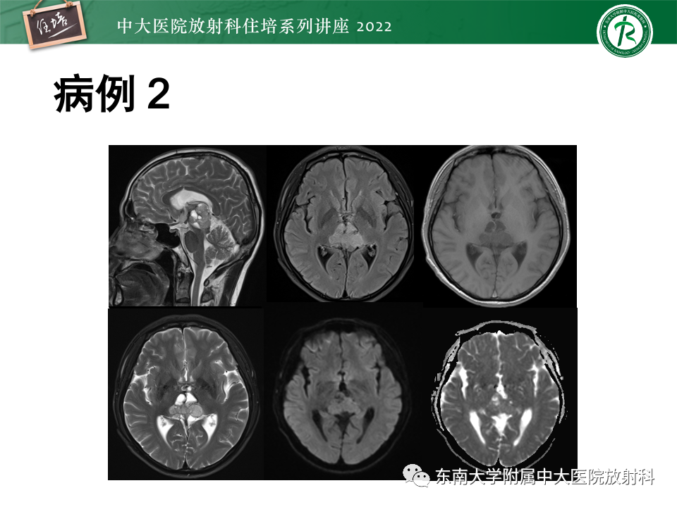 【PPT】松果体区占位性病变的诊断思路-22