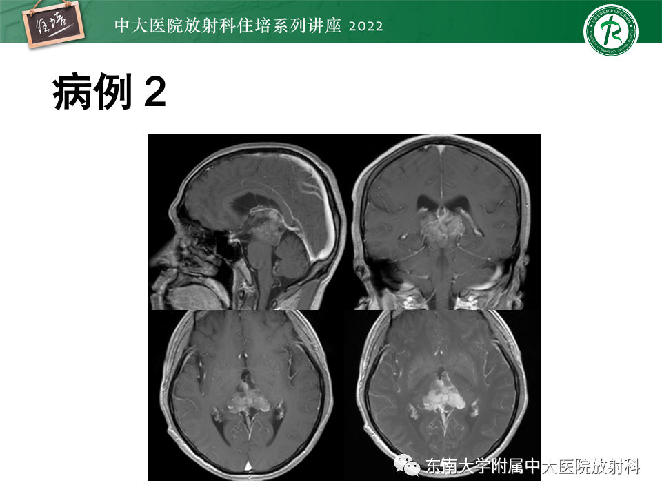 【PPT】松果体区占位性病变的诊断思路-23