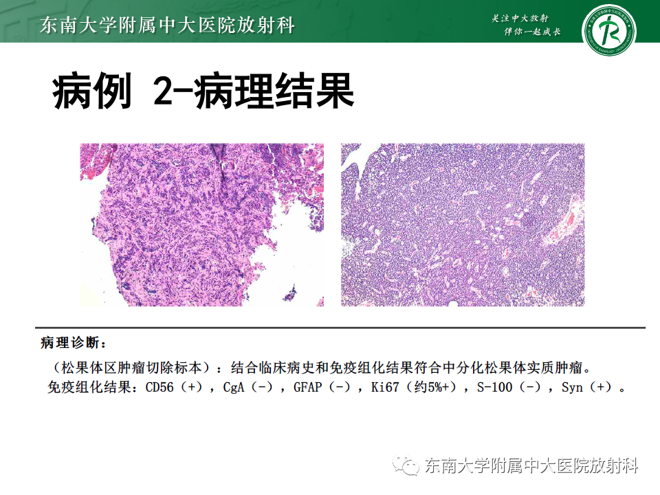 【PPT】松果体区占位性病变的诊断思路-25