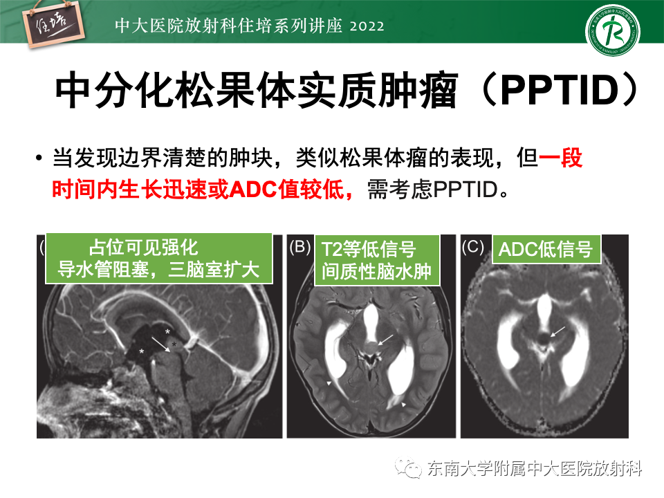 【PPT】松果体区占位性病变的诊断思路-31