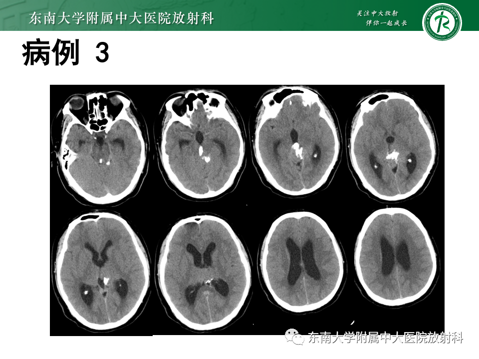 【PPT】松果体区占位性病变的诊断思路-33