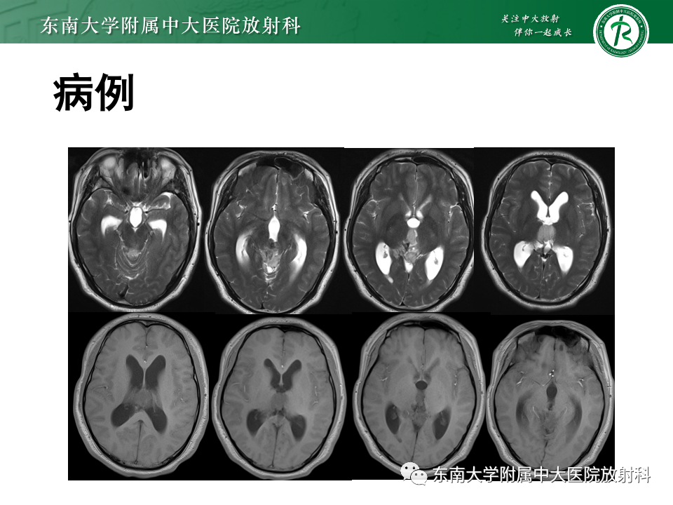 【PPT】松果体区占位性病变的诊断思路-35