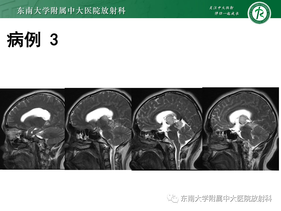 【PPT】松果体区占位性病变的诊断思路-34