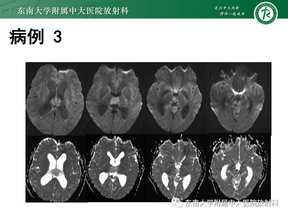 【PPT】松果体区占位性病变的诊断思路-36