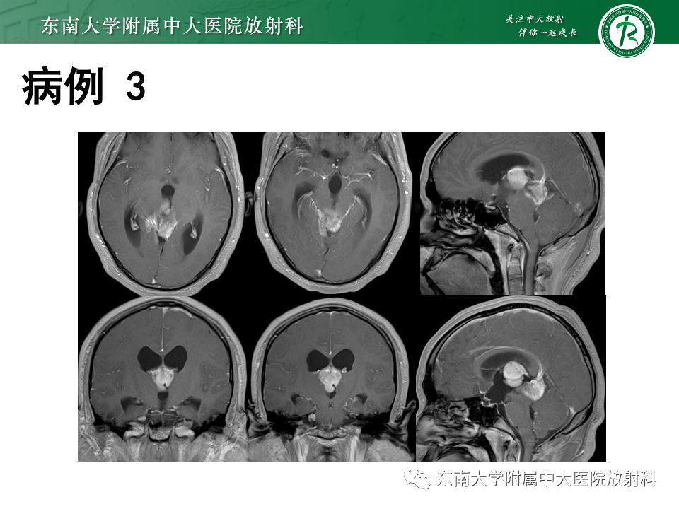 【PPT】松果体区占位性病变的诊断思路-37