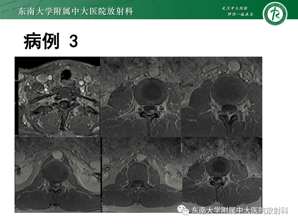 【PPT】松果体区占位性病变的诊断思路-38