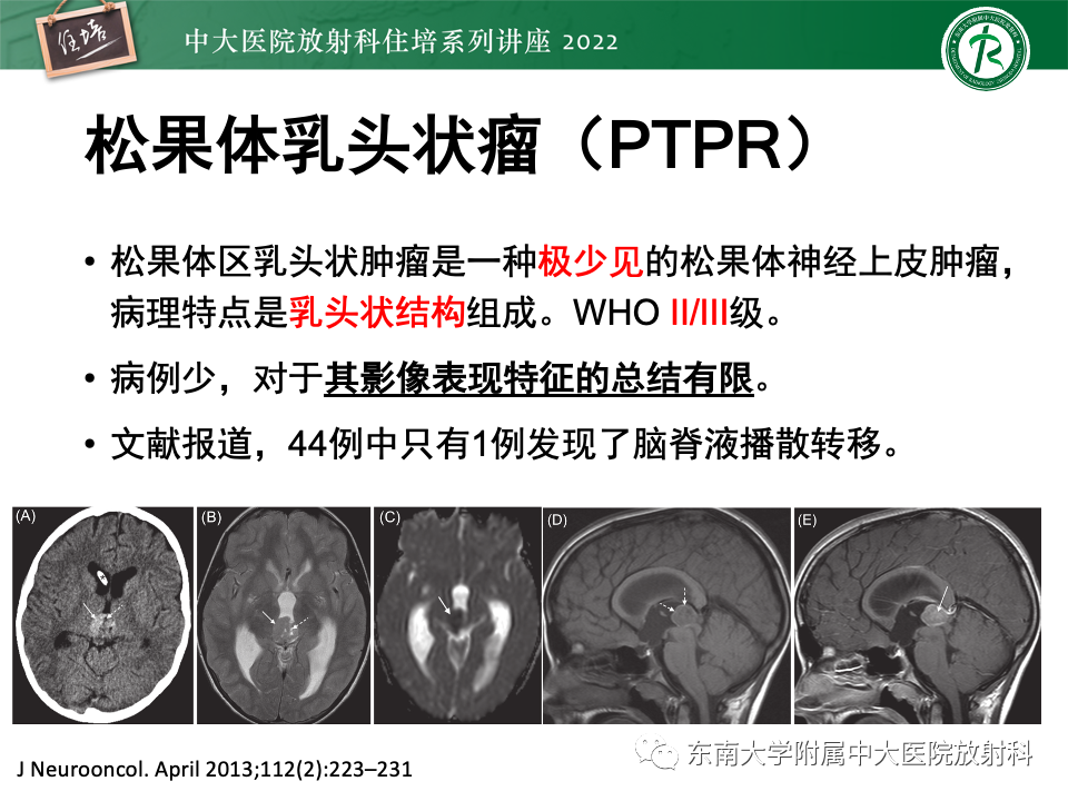 【PPT】松果体区占位性病变的诊断思路-43