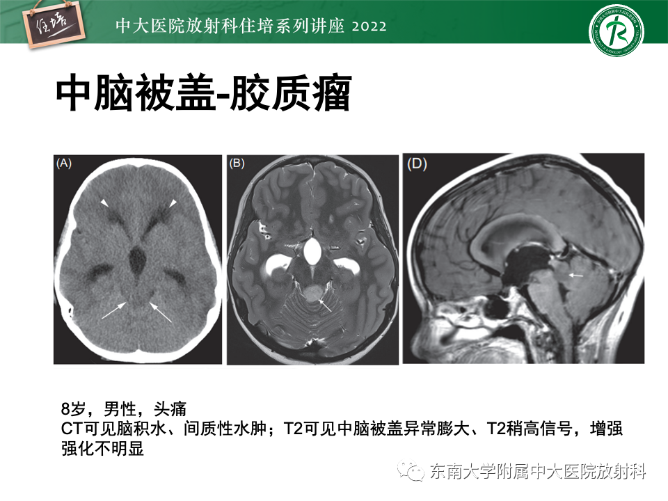 【PPT】松果体区占位性病变的诊断思路-45