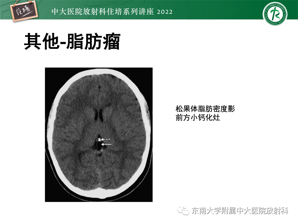 【PPT】松果体区占位性病变的诊断思路-47