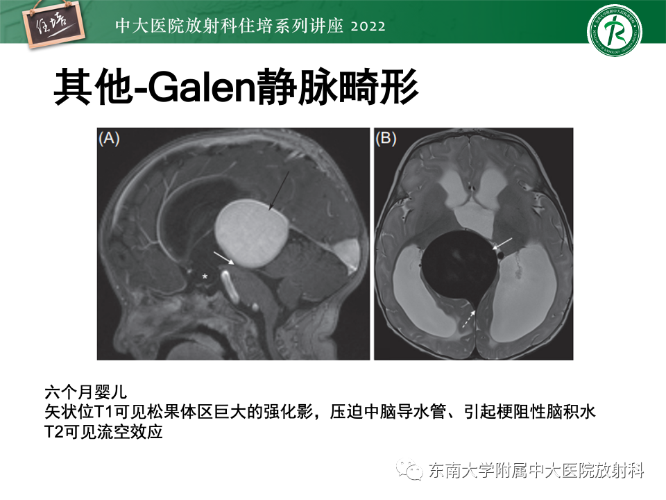 【PPT】松果体区占位性病变的诊断思路-48