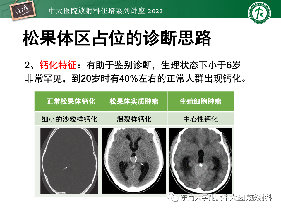 【PPT】松果体区占位性病变的诊断思路-50