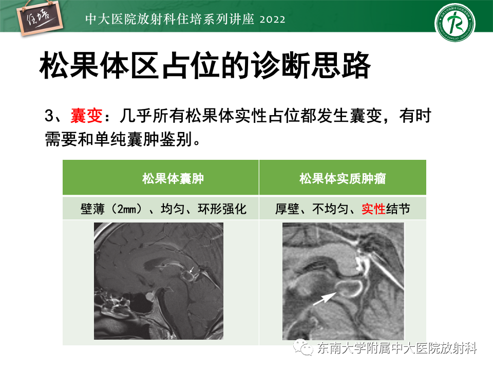 【PPT】松果体区占位性病变的诊断思路-51