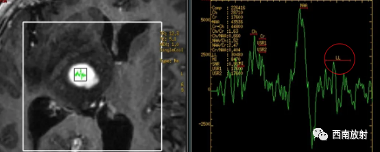 原发性中枢神经系统淋巴瘤-5