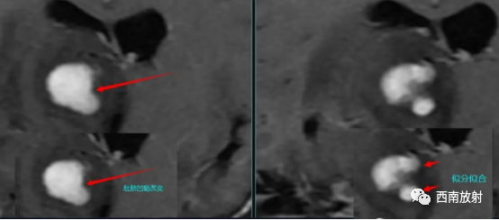 原发性中枢神经系统淋巴瘤-4