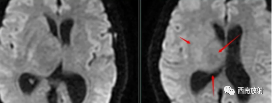 原发性中枢神经系统淋巴瘤-2
