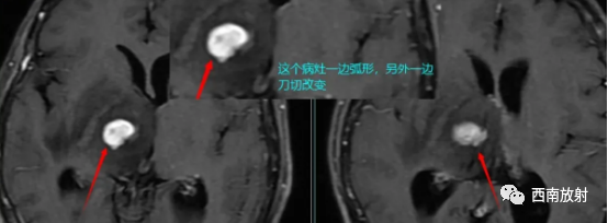 原发性中枢神经系统淋巴瘤-3
