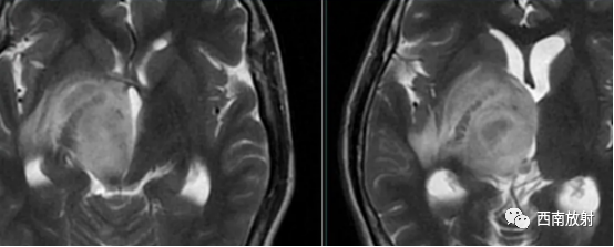 原发性中枢神经系统淋巴瘤-1