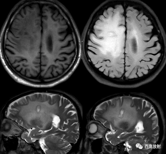 原发性中枢神经系统淋巴瘤-6