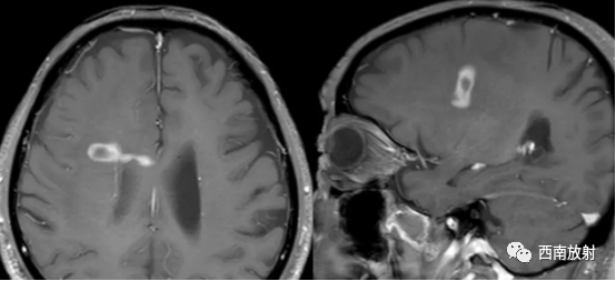 原发性中枢神经系统淋巴瘤-7