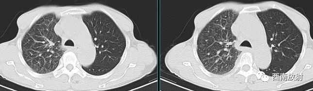 原发性中枢神经系统淋巴瘤-8